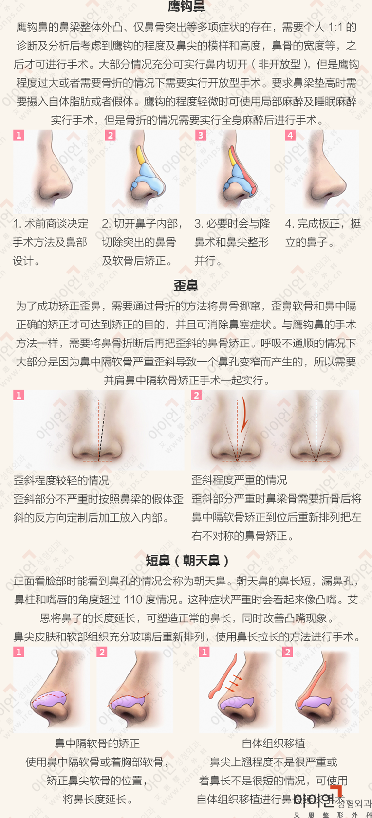 各类型鼻部整形