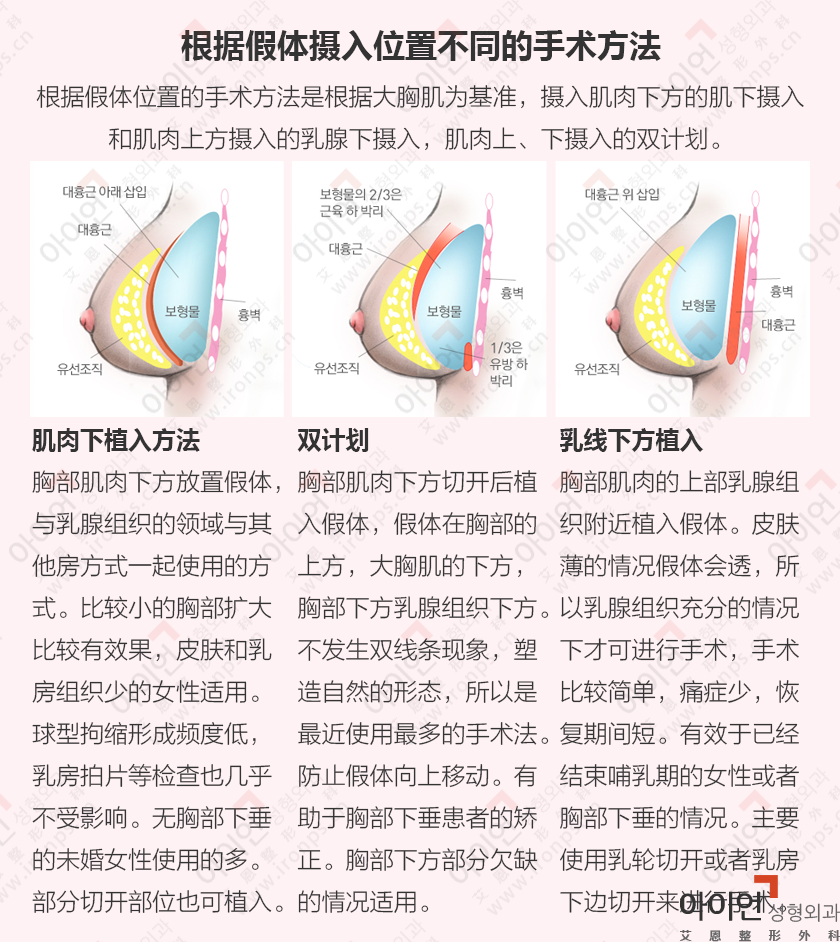 隆胸手术