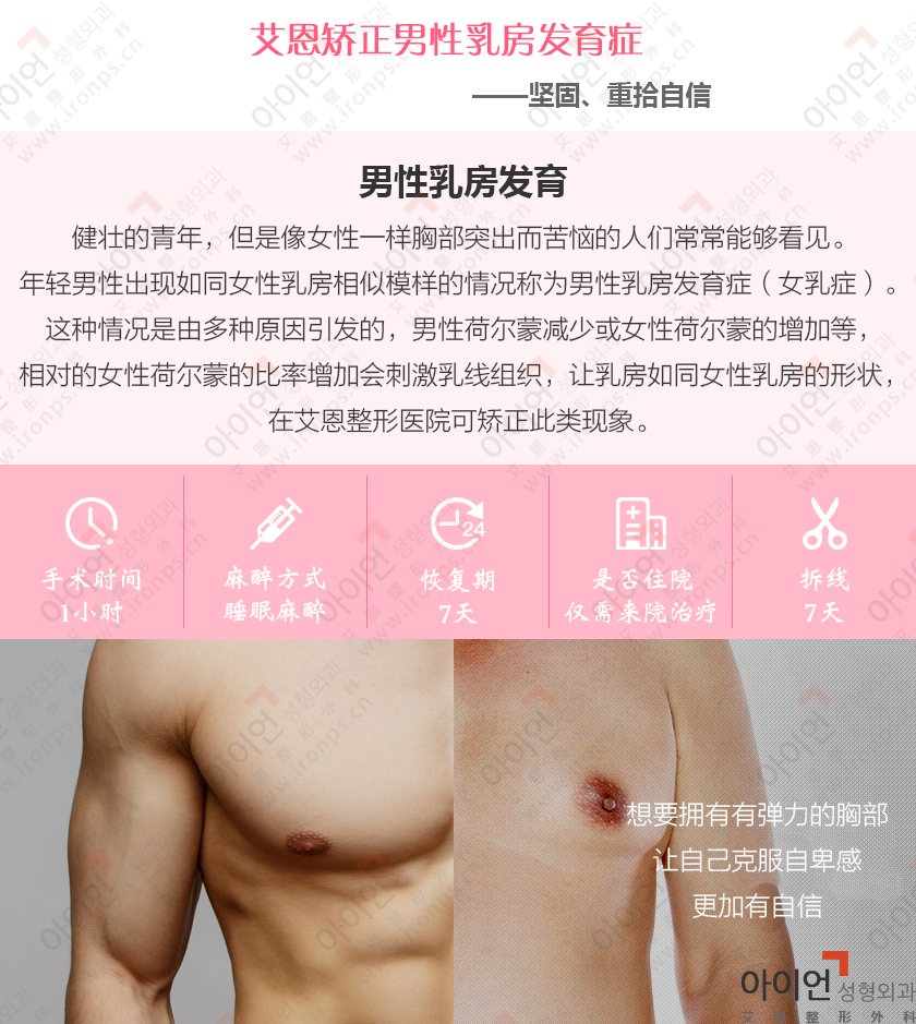 男性乳房发育症