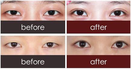 埋线双眼皮跟切开双眼皮哪个效果更持久?